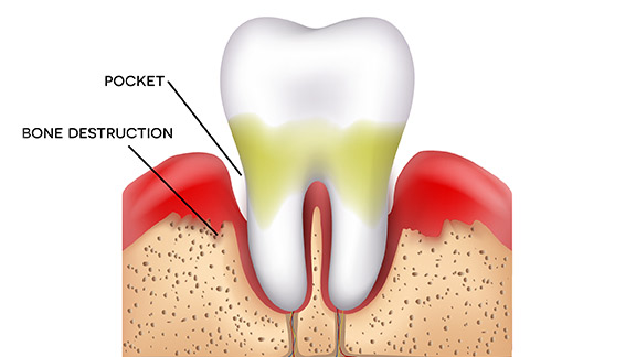 About Gum Disease Midtown Manhattan, NY