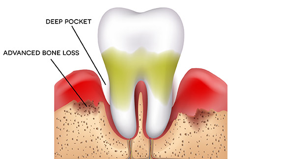 About Gum Disease Midtown Manhattan, NY