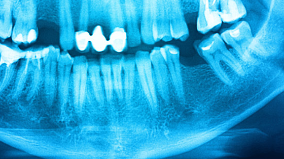 Bone Grafting Midtown Manhattan, NY