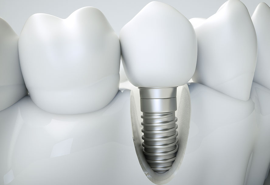 Dental Implants Midtown Manhattan, NY